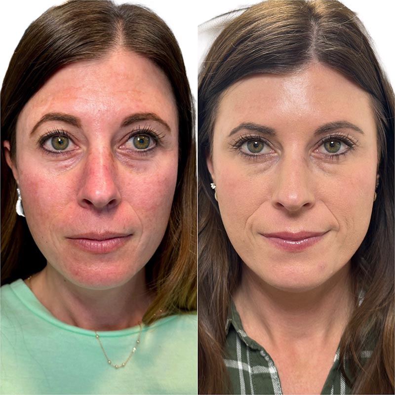 Botox Before & After Image