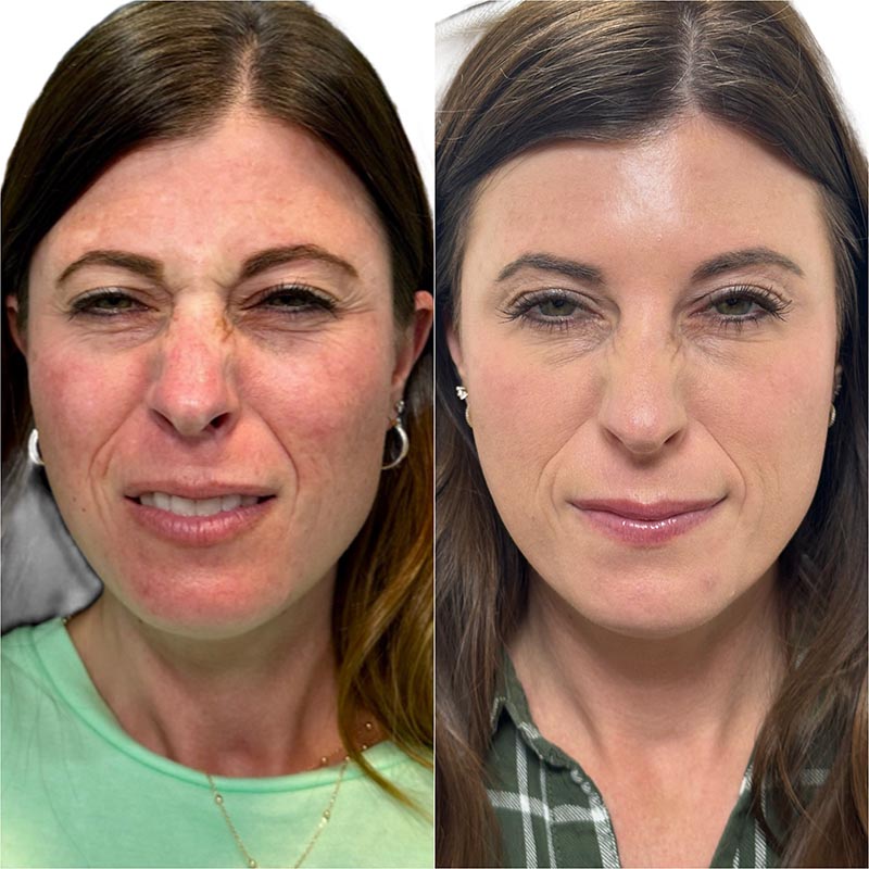 Botox Before & After Image