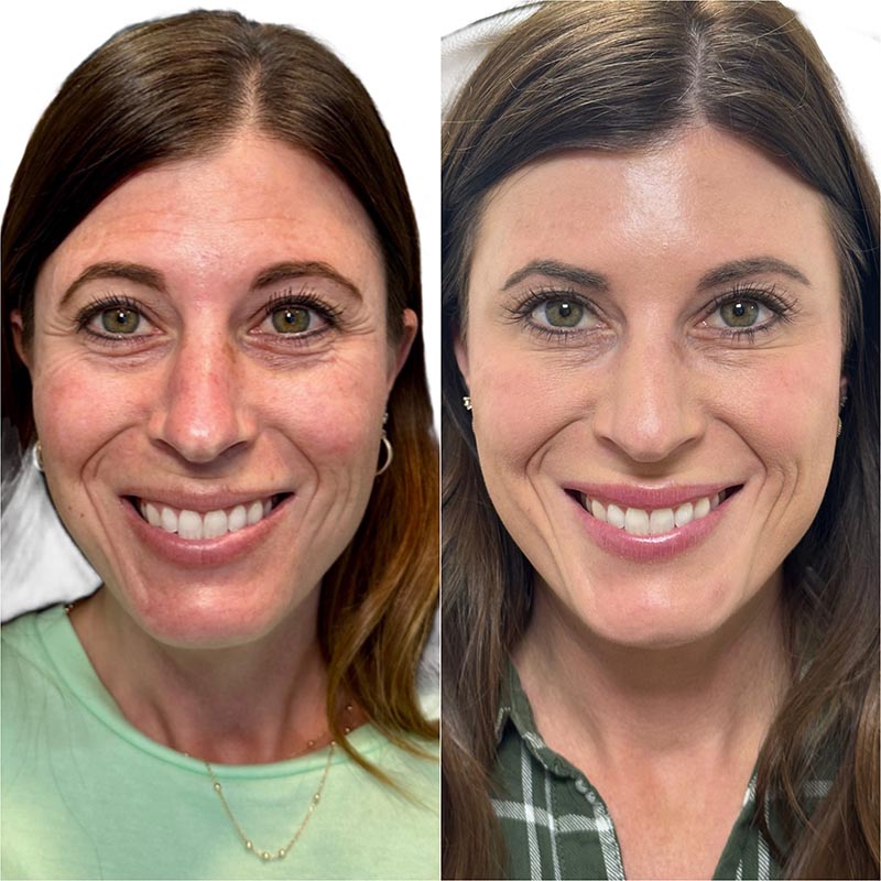 Botox Before & After Image
