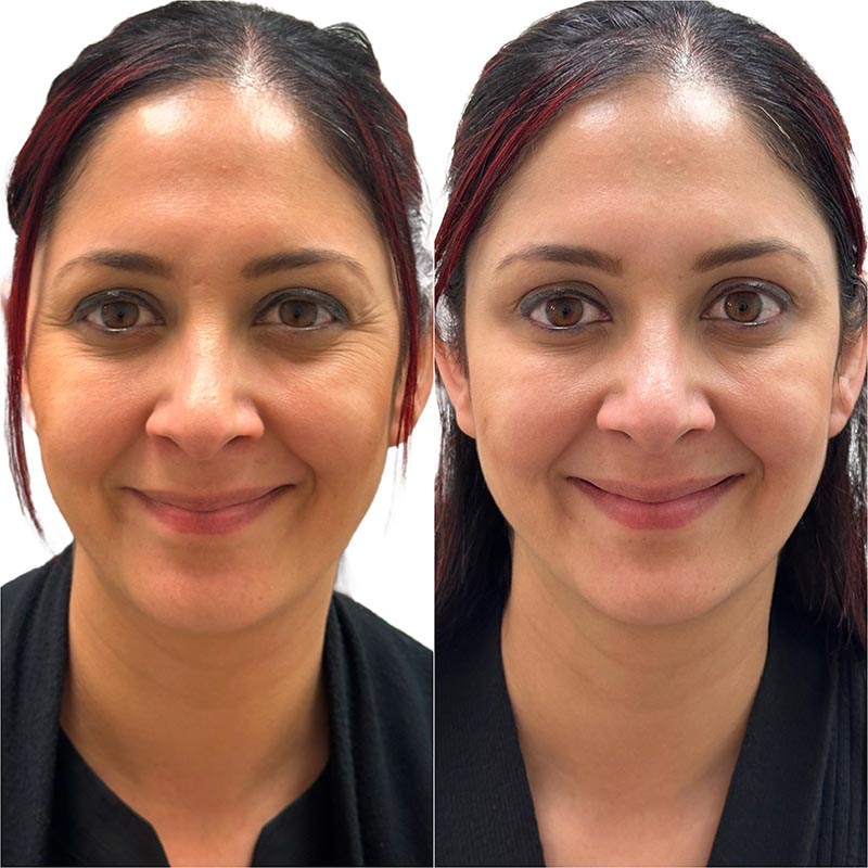 Botox Before & After Image