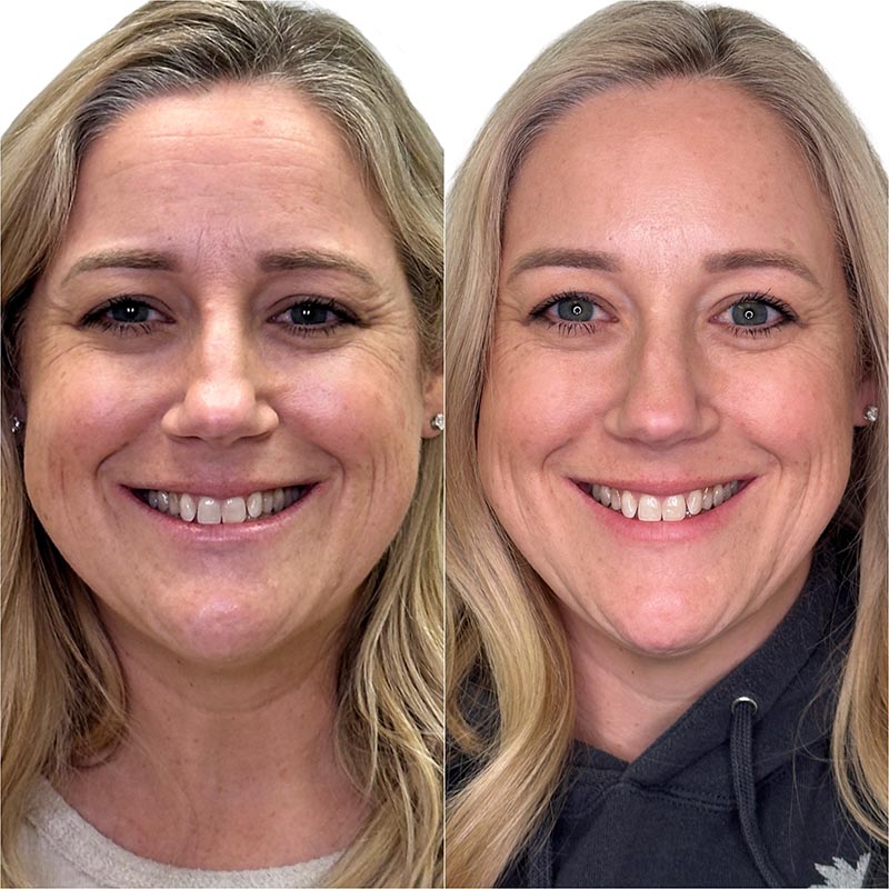 Botox Before & After Image