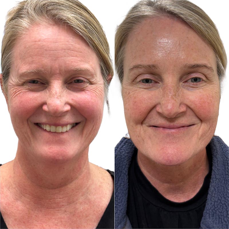 Botox Before & After Image