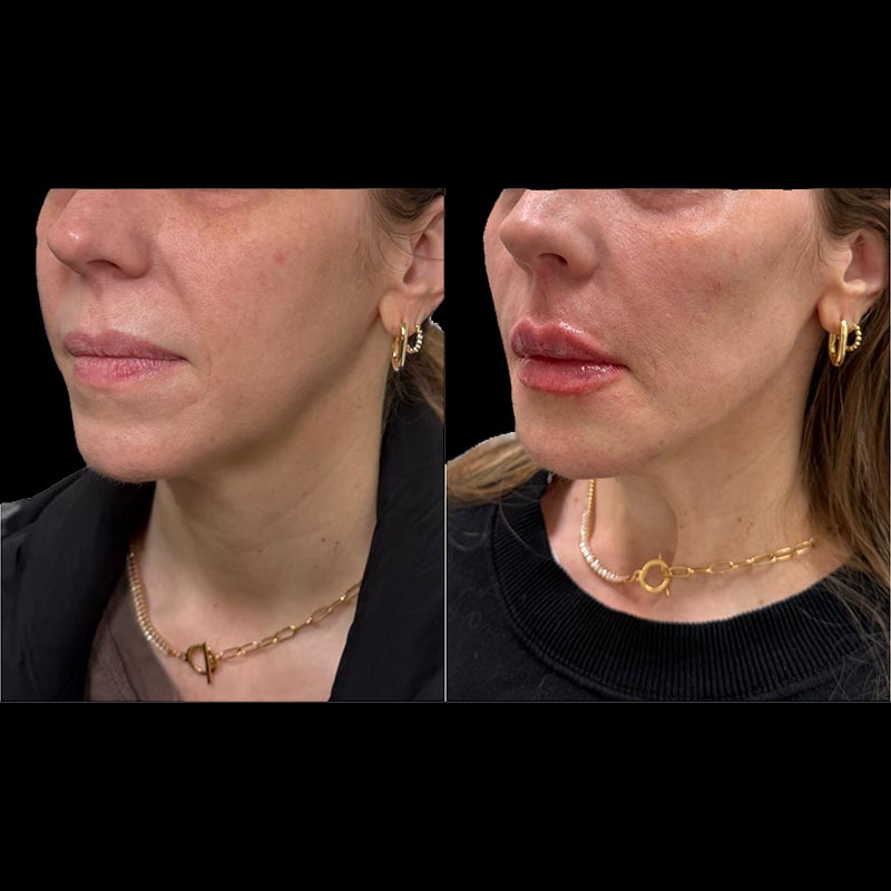 Dermal Fillers Before & After Image