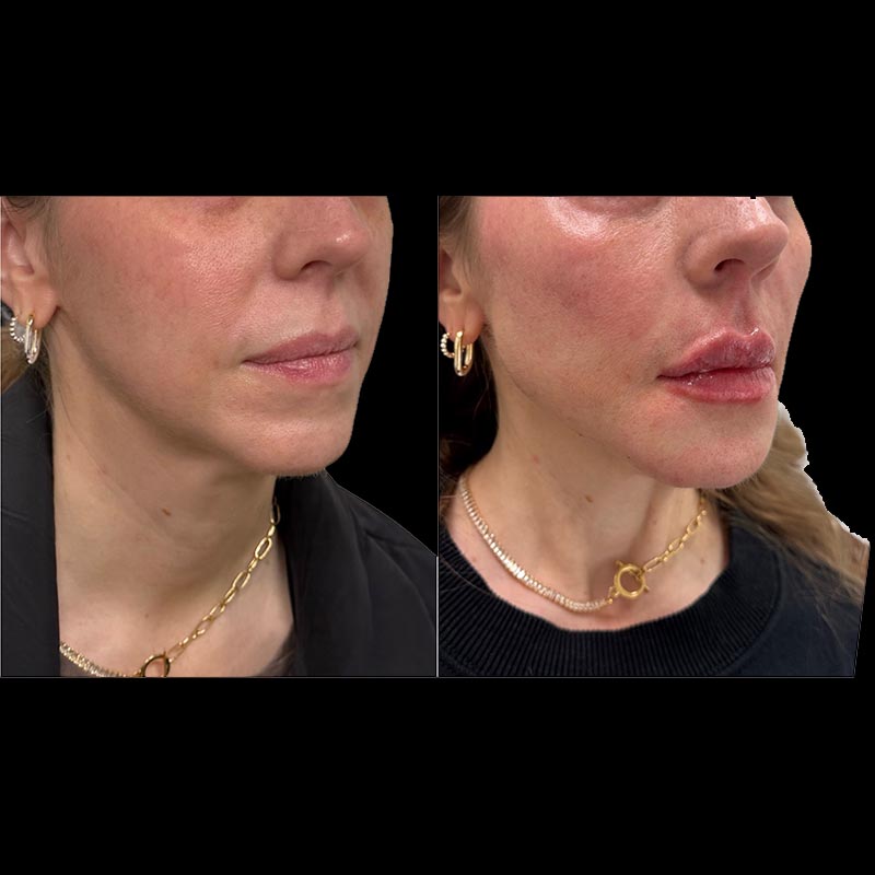 Dermal Fillers Before & After Image