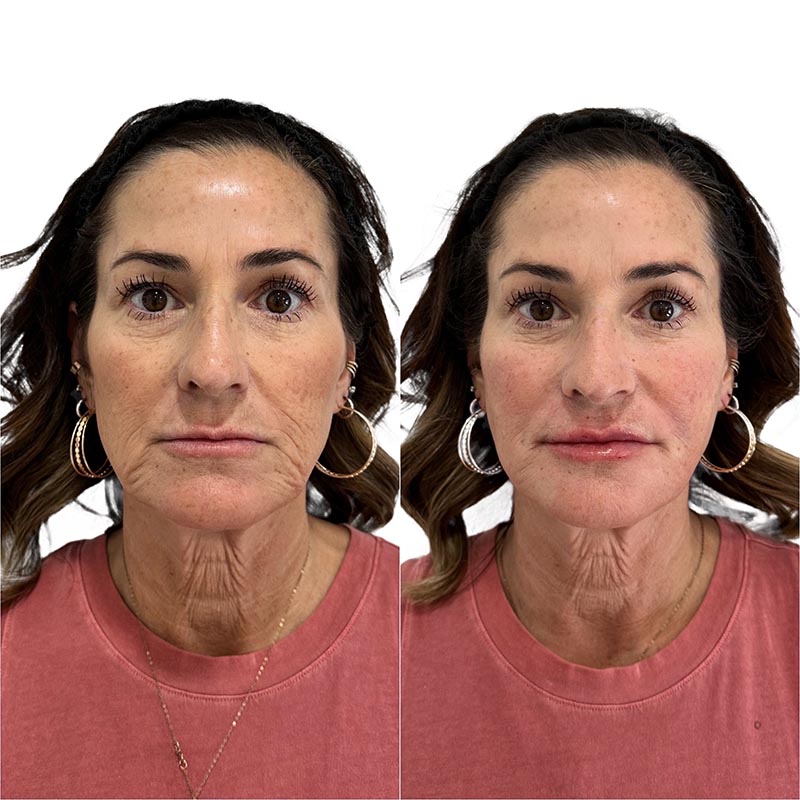Dermal Fillers Before & After Image