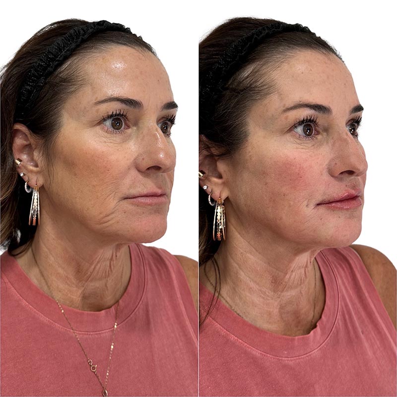 Dermal Fillers Before & After Image