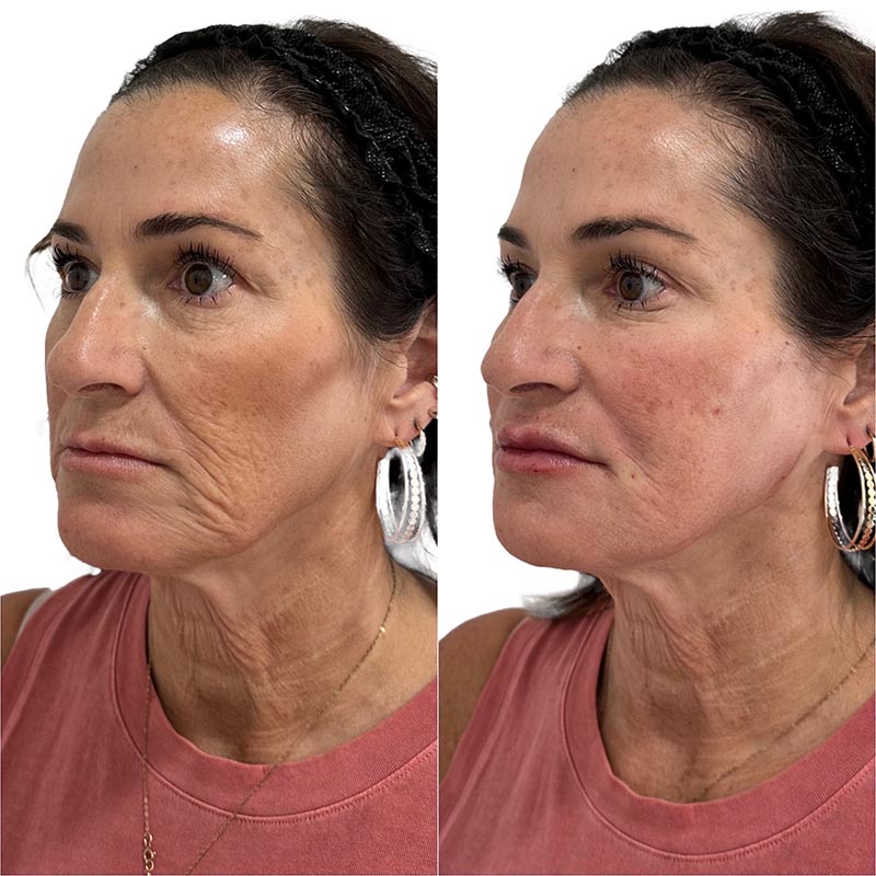 Dermal Fillers Before & After Image