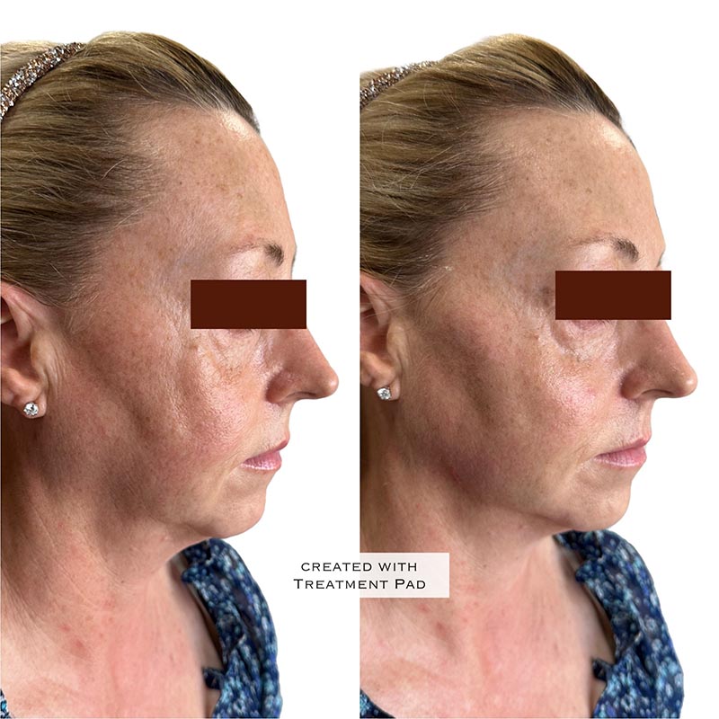 Dermal Fillers Before & After Image