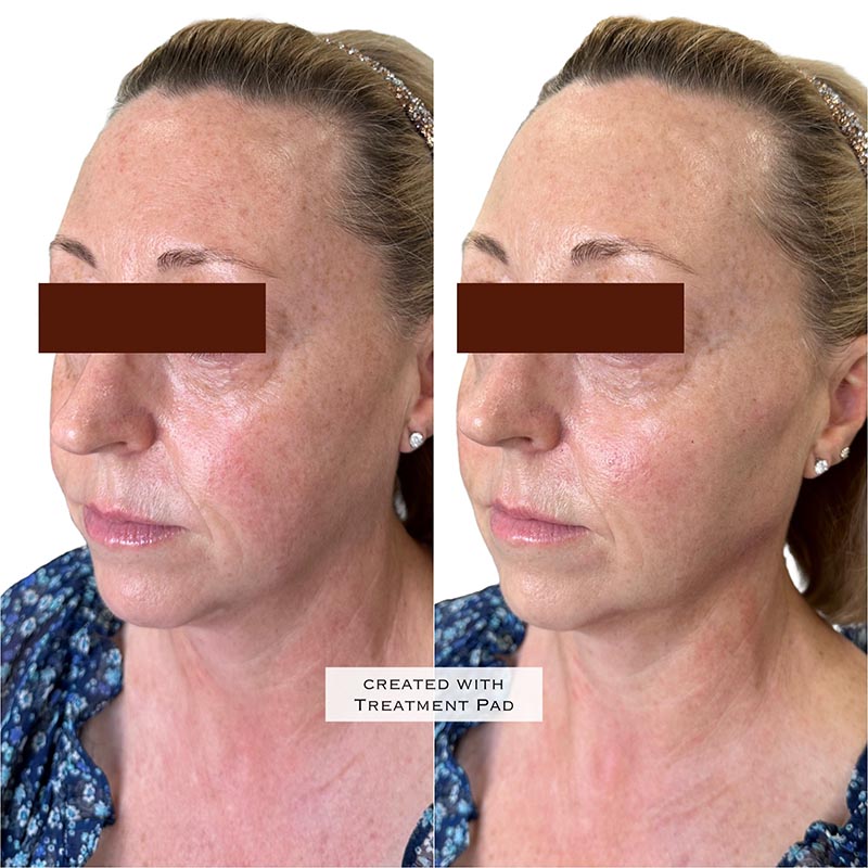 Dermal Fillers Before & After Image