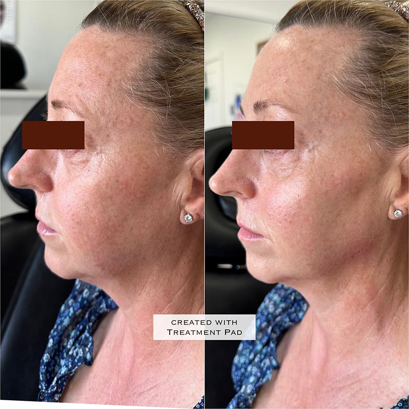 Dermal Fillers Before & After Image