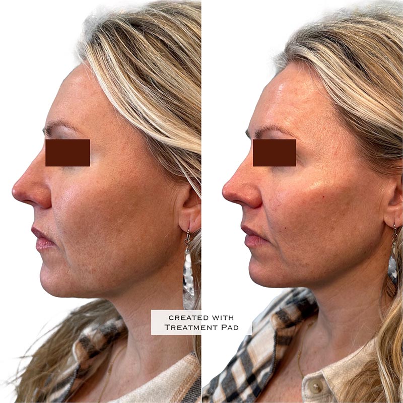 Dermal Fillers Before & After Image