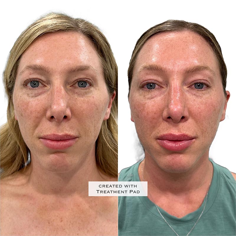 Dermal Fillers Before & After Image