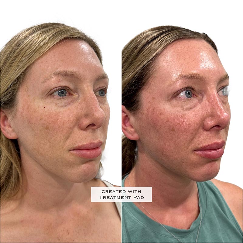 Dermal Fillers Before & After Image