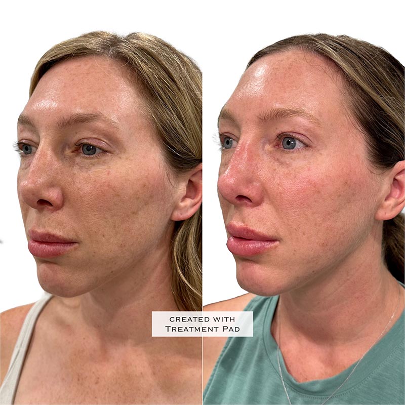 Dermal Fillers Before & After Image
