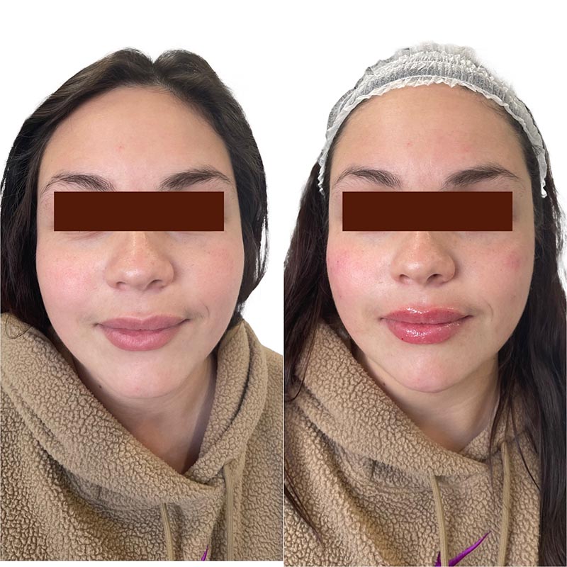 Dermal Fillers Before & After Image