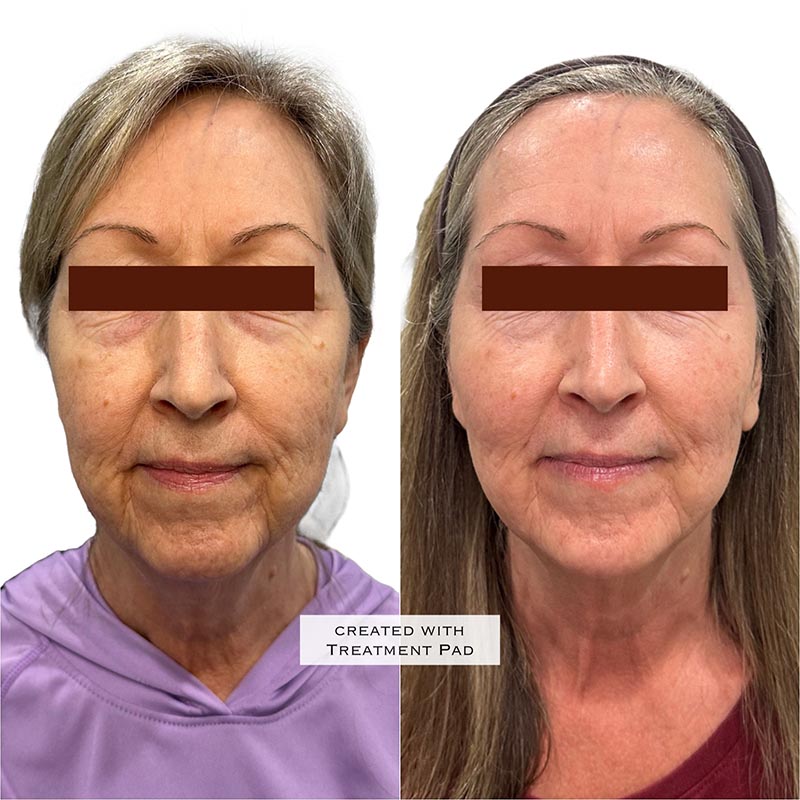 Dermal Fillers Before & After Image