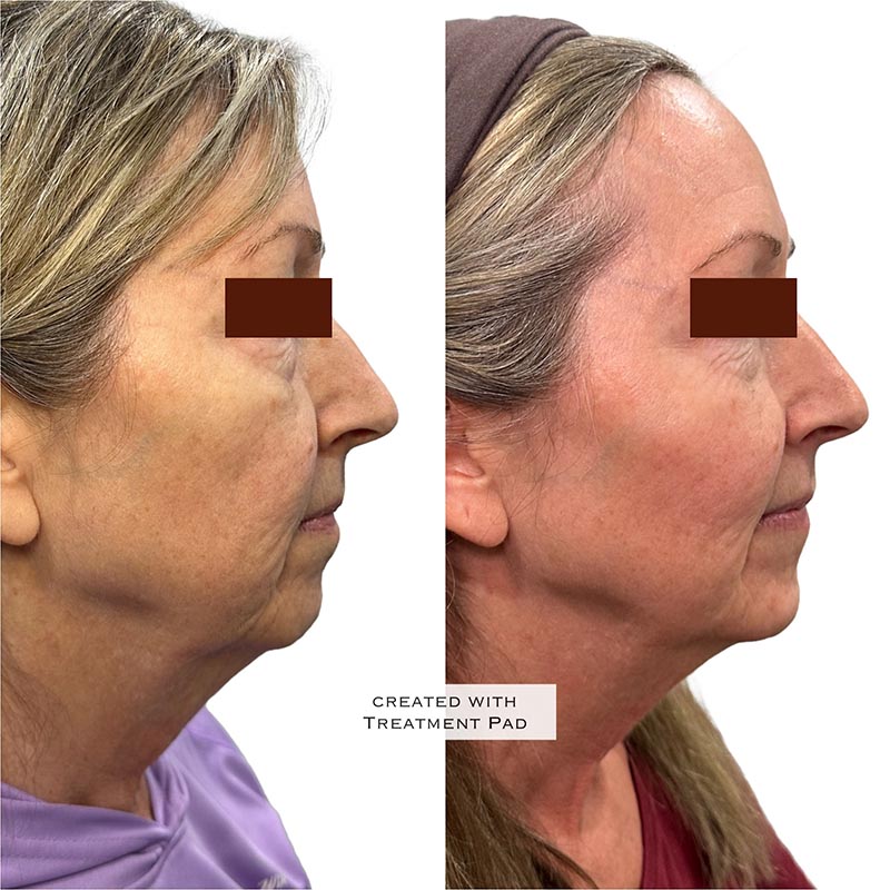 Dermal Fillers Before & After Image