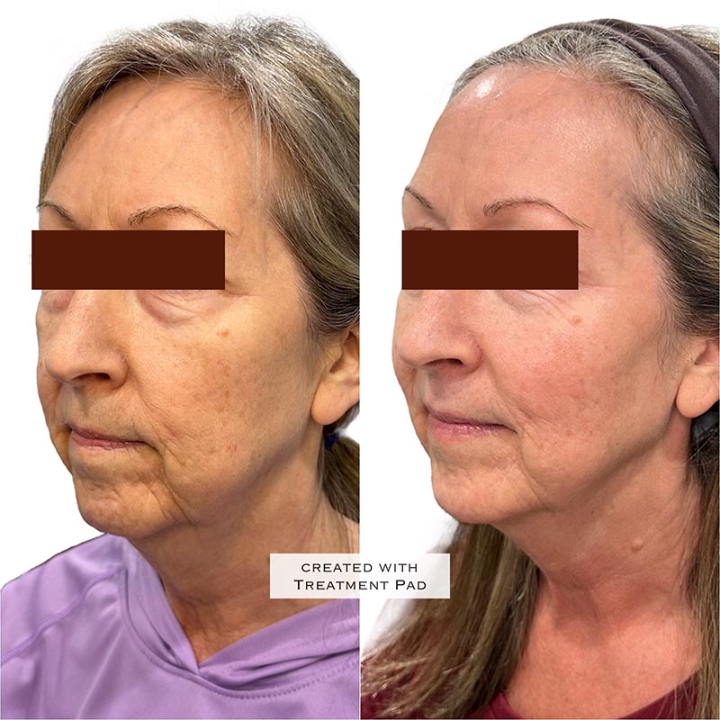 Dermal Fillers Before & After Image
