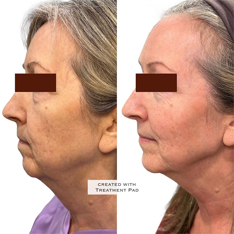 Dermal Fillers Before & After Image