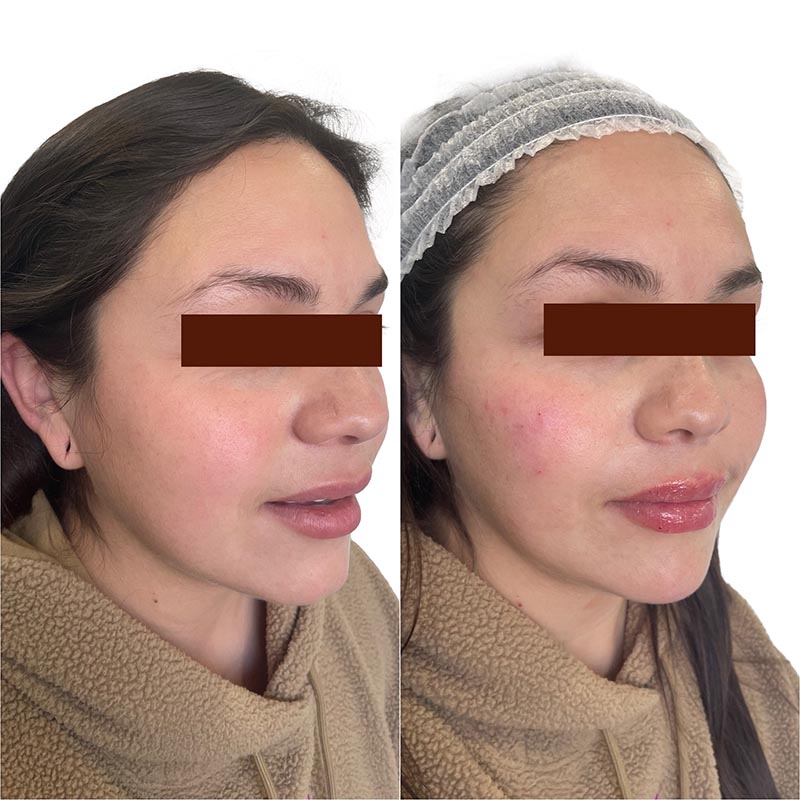 Dermal Fillers Before & After Image