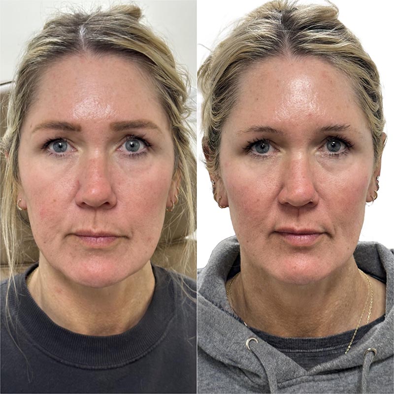 Dermal Fillers Before & After Image