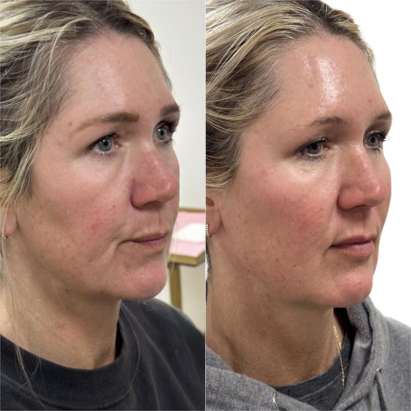 Dermal Fillers Before & After Image