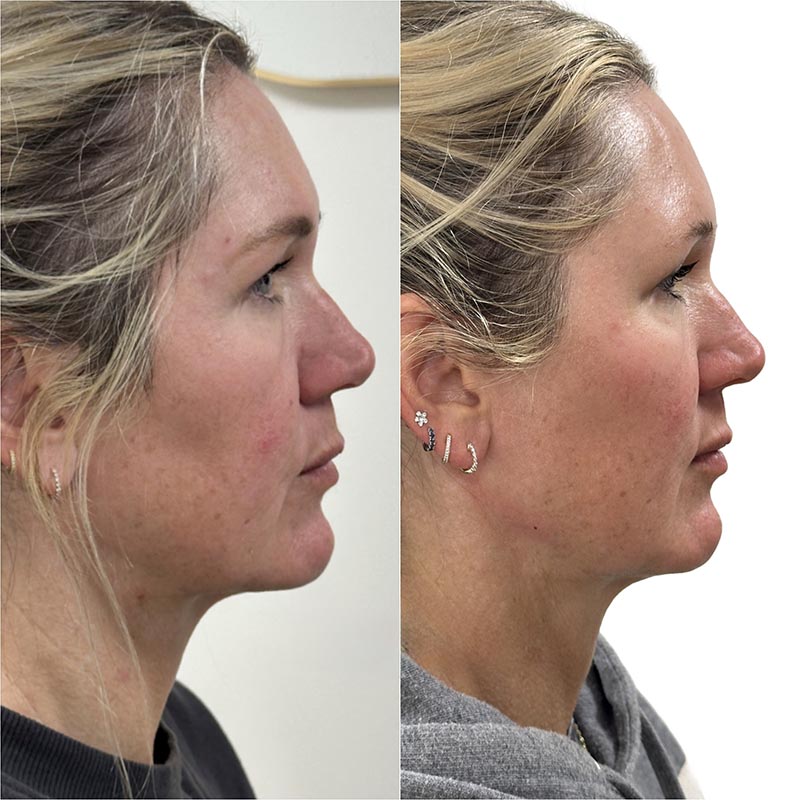Dermal Fillers Before & After Image