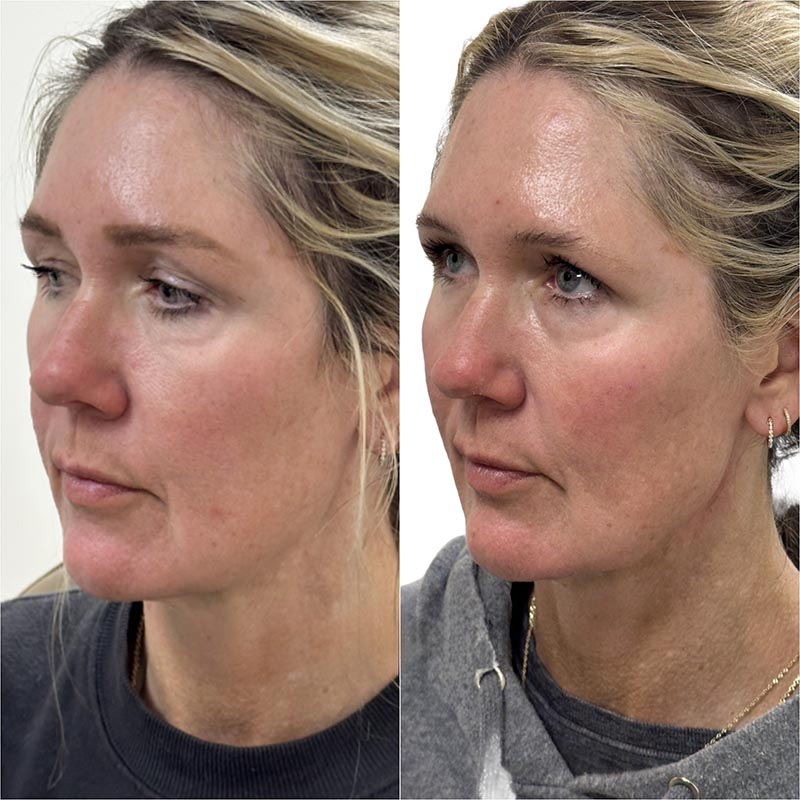 Dermal Fillers Before & After Image