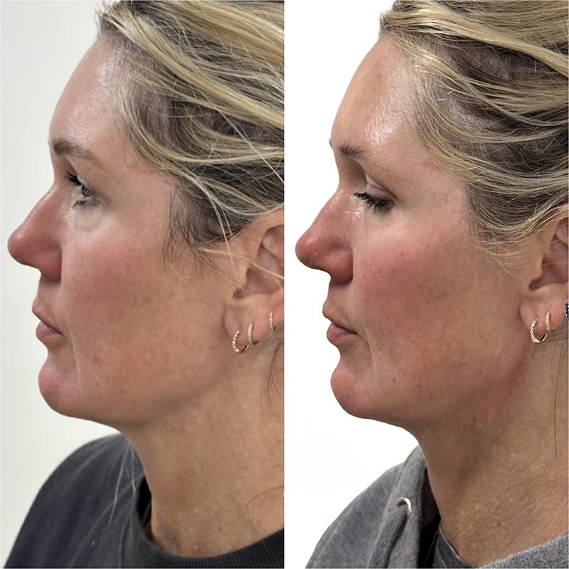 Dermal Fillers Before & After Image