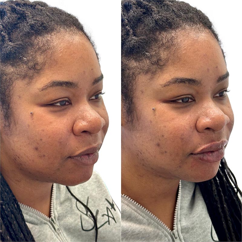 Dermal Fillers Before & After Image