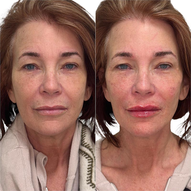 Dermal Fillers Before & After Image