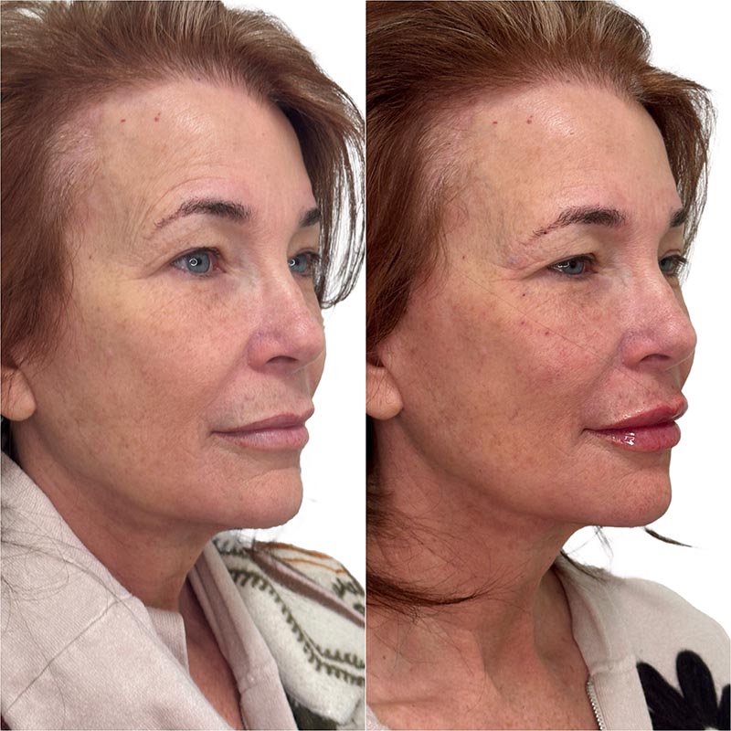 Dermal Fillers Before & After Image