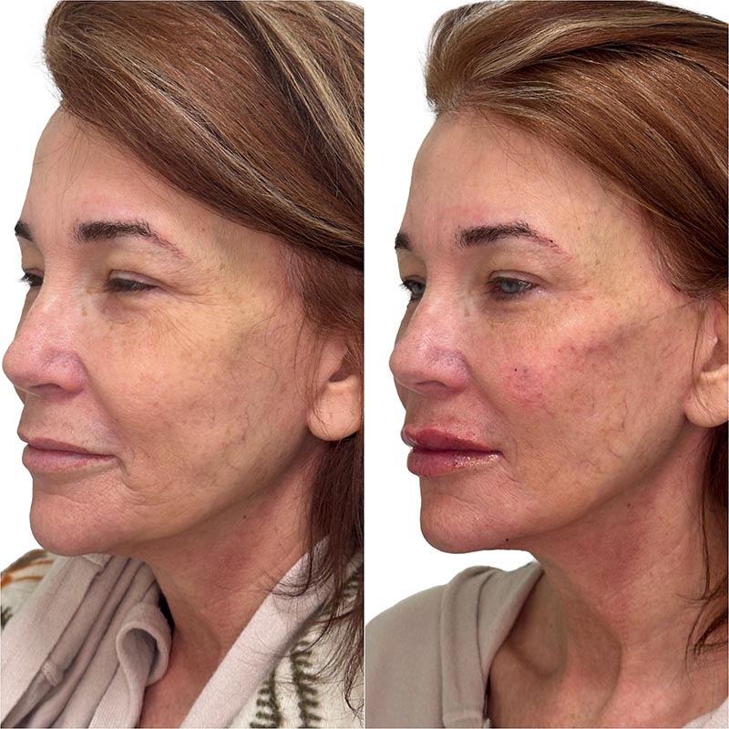 Dermal Fillers Before & After Image