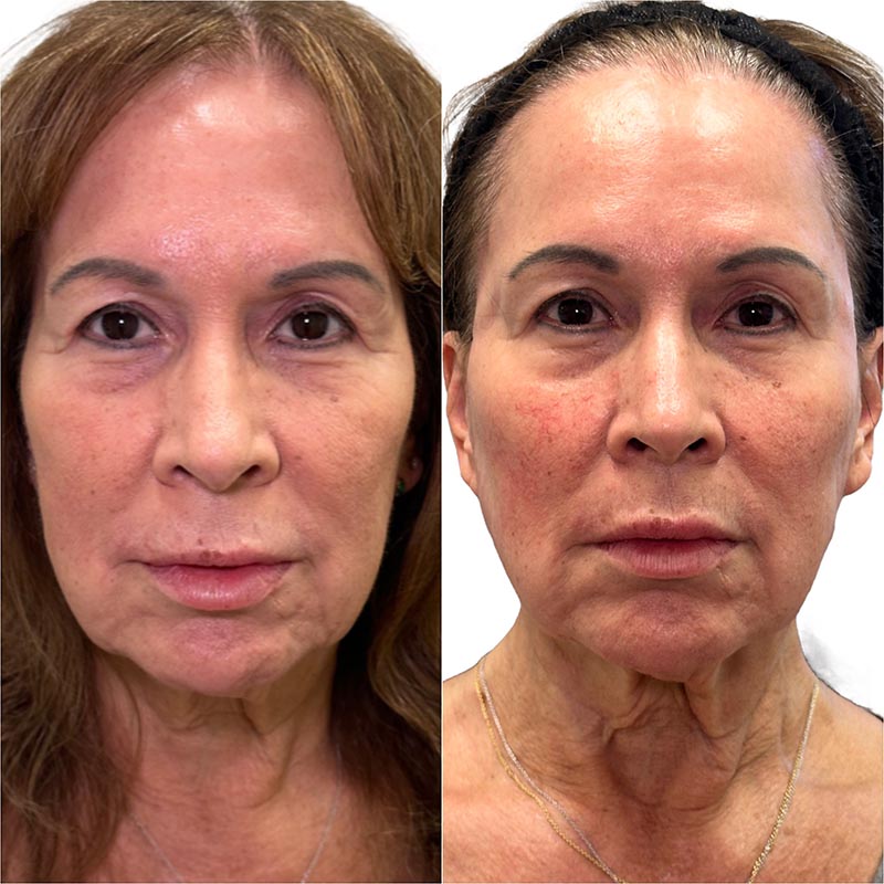 Dermal Fillers Before & After Image
