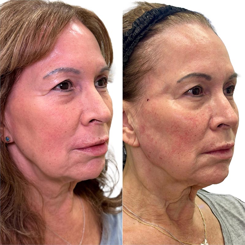 Dermal Fillers Before & After Image