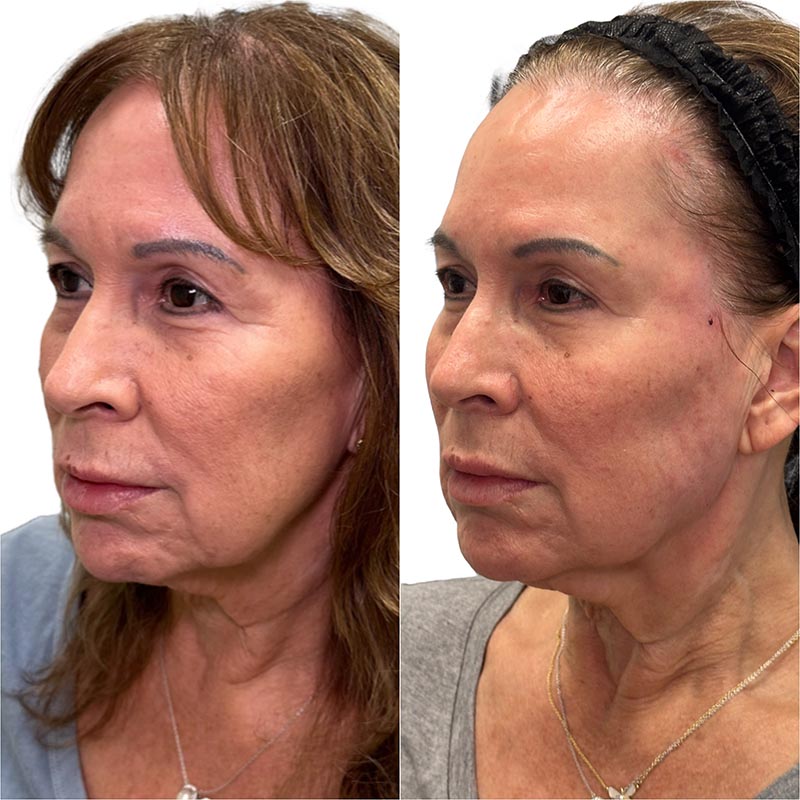 Dermal Fillers Before & After Image