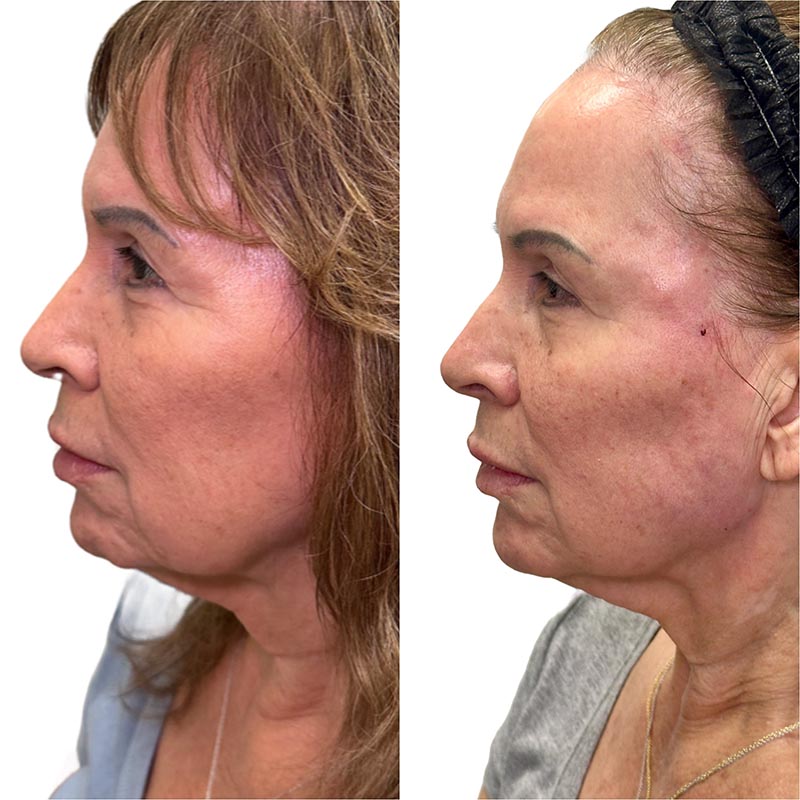 Dermal Fillers Before & After Image