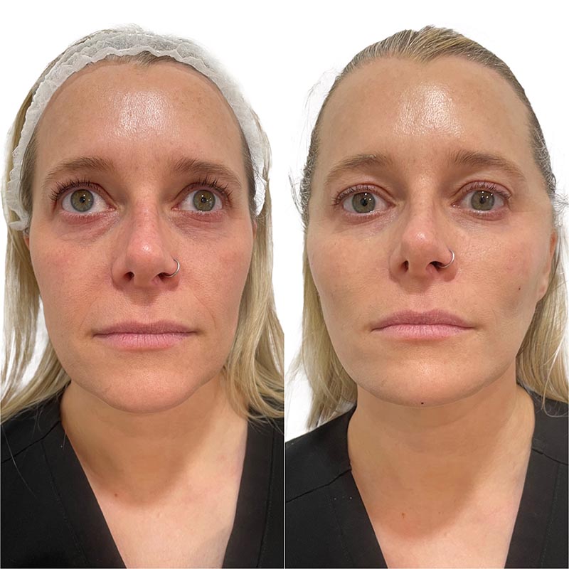 Dermal Fillers Before & After Image
