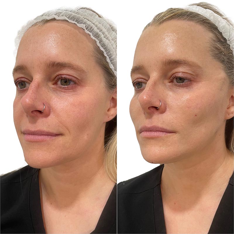 Dermal Fillers Before & After Image