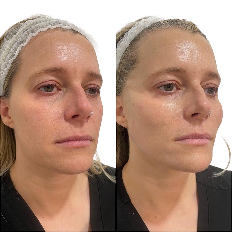 Dermal Fillers Before & After Image