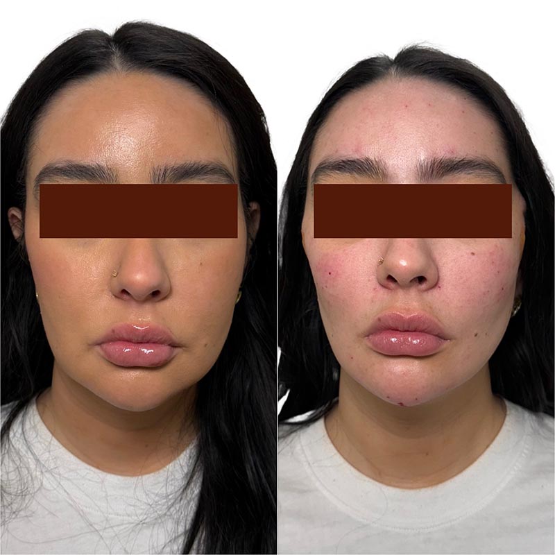 Dermal Fillers Before & After Image