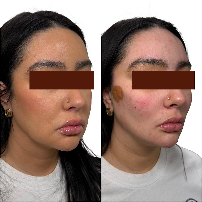 Dermal Fillers Before & After Image