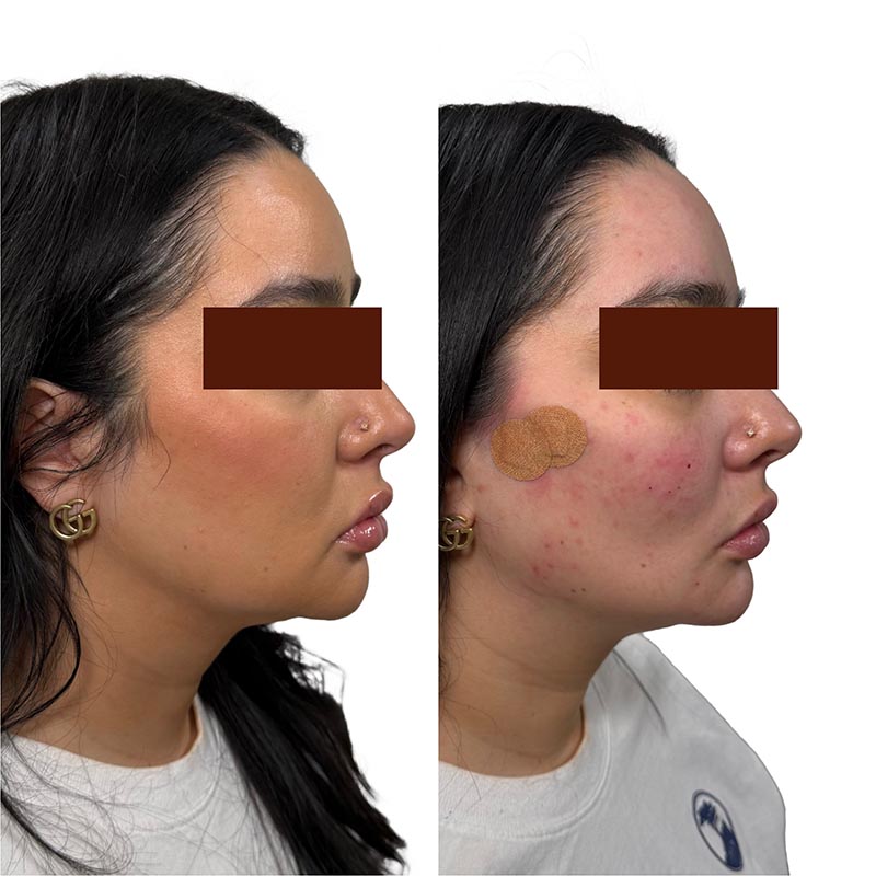 Dermal Fillers Before & After Image