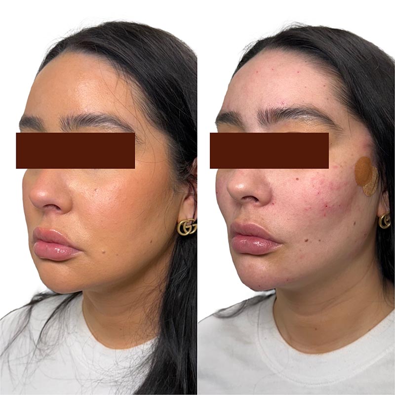 Dermal Fillers Before & After Image