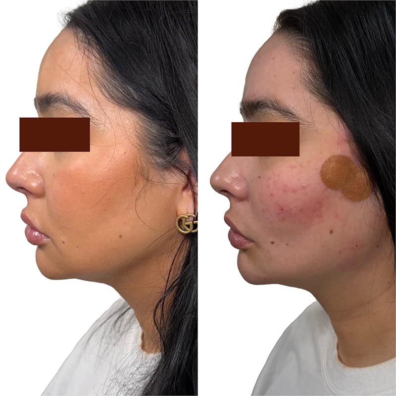 Dermal Fillers Before & After Image