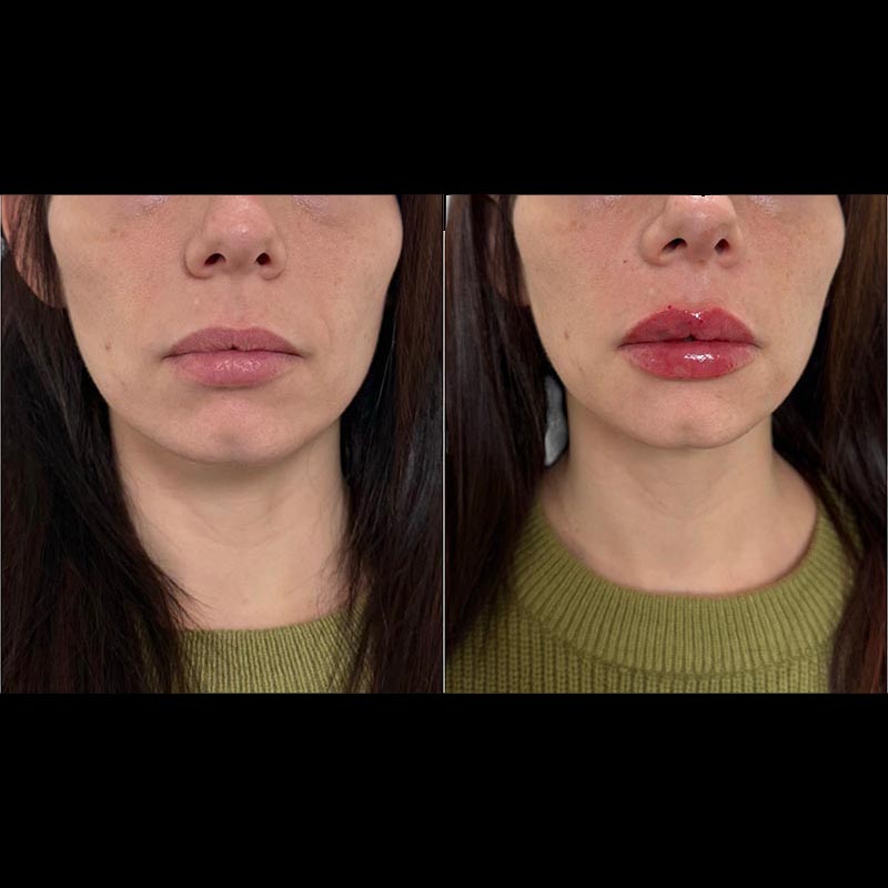 Lip Enhancement Before & After Image