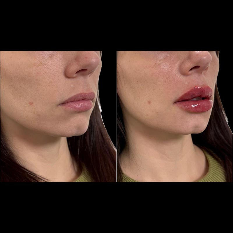 Lip Enhancement Before & After Image