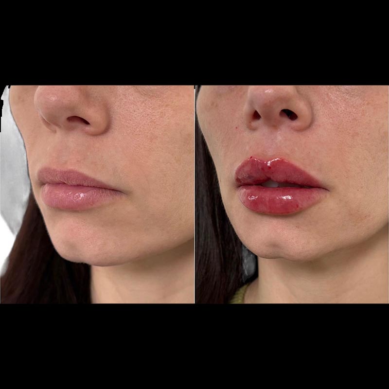 Lip Enhancement Before & After Image