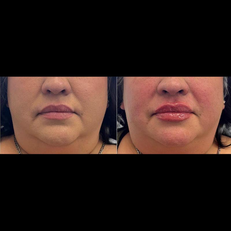 Lip Enhancement Before & After Image