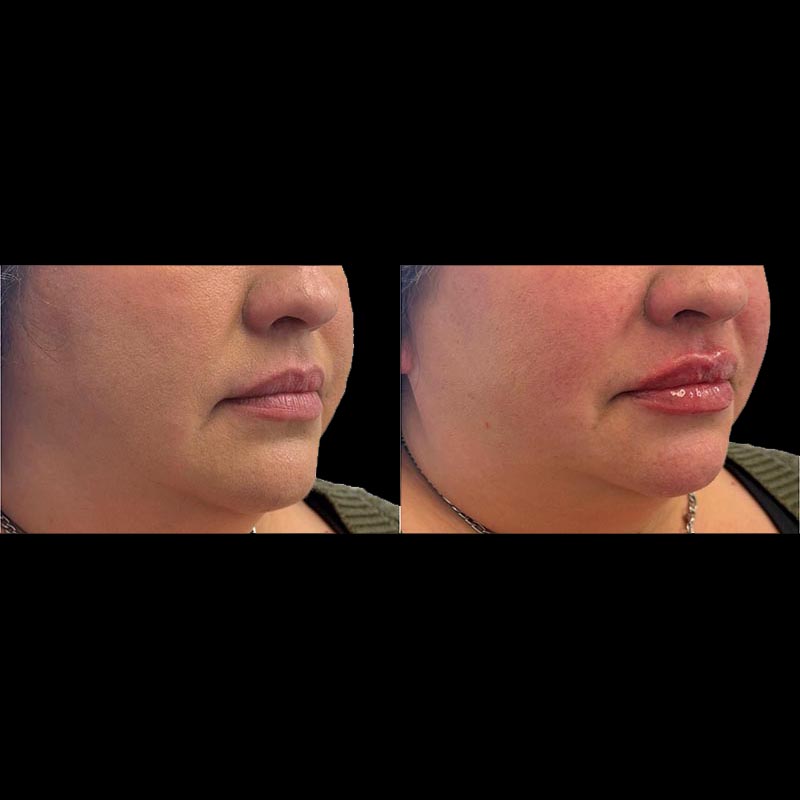 Lip Enhancement Before & After Image
